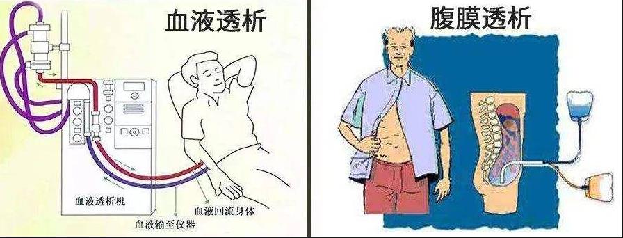 血液透析滤过的优缺点