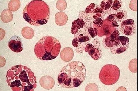 怎么确定慢性肾炎