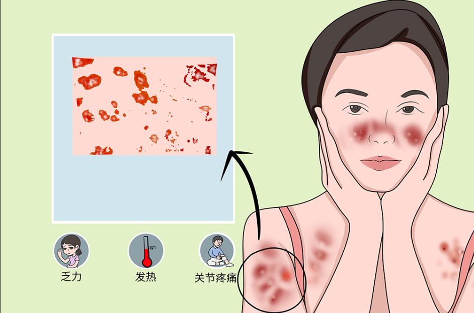 红斑狼疮有哪些症状?怎么样预防红斑狼疮疾病? 红斑狼疮有哪些症状?怎么样预防红斑狼疮疾病?